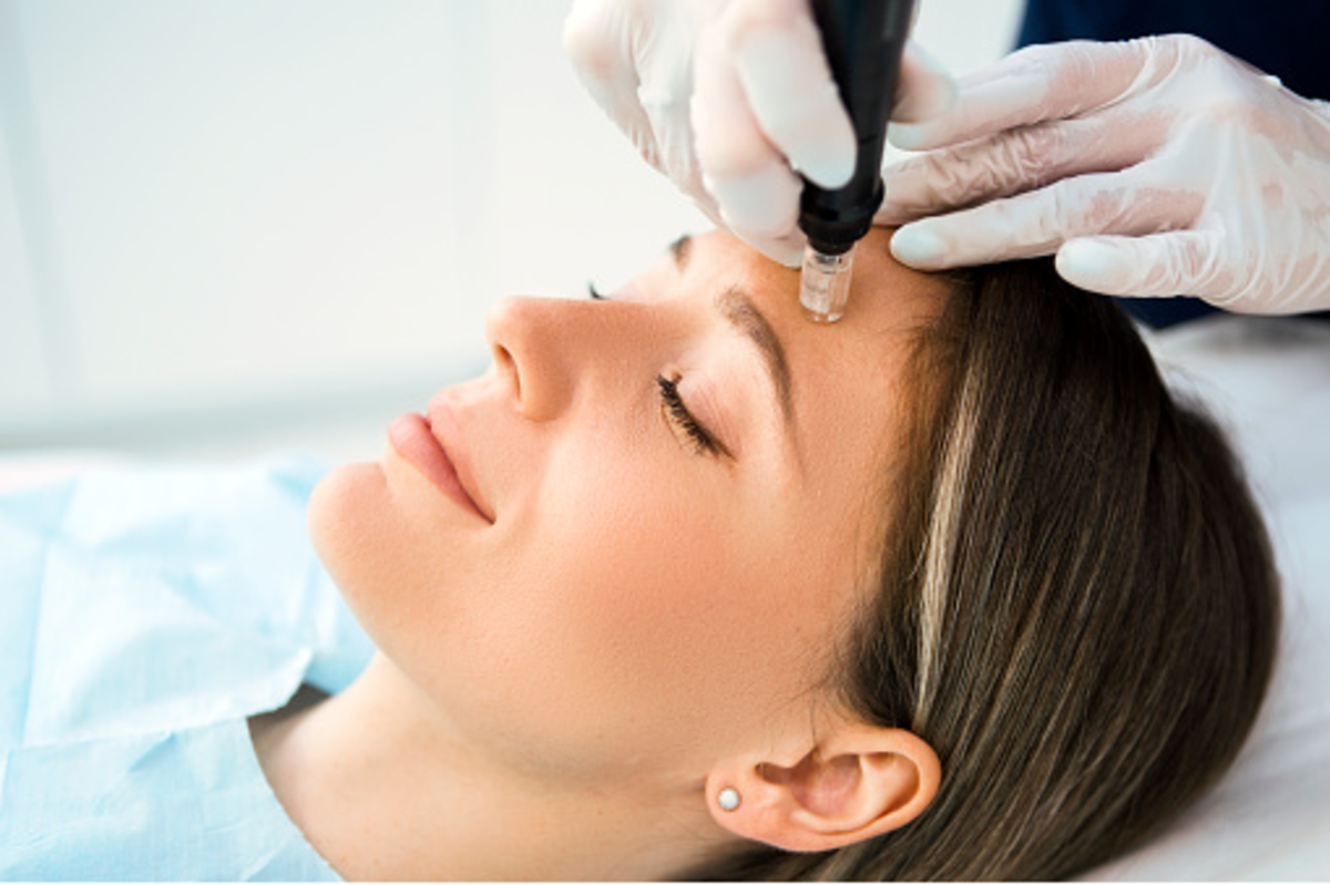 Eye brow Thread Lift